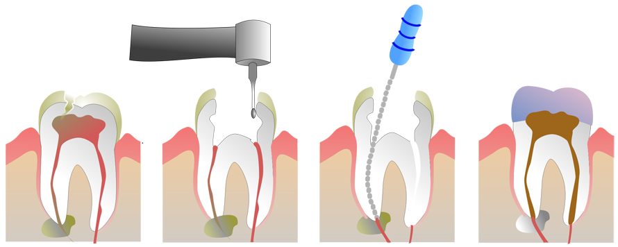 Come si devitalizza un dente
