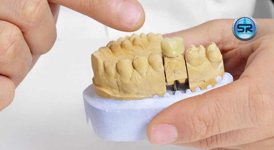 Domande sulle protesi dentali