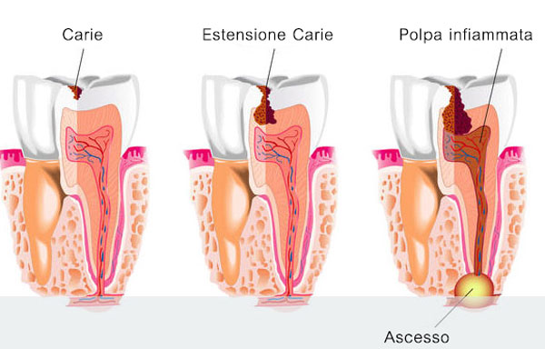 Endodonzia | Terapia Endodontica | Devitalizzazione dente