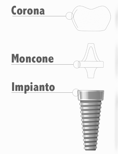 Protesi impianto moncone | Posizionamento impianti dentali
